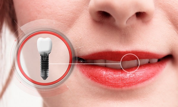 Dental implant and smiling woman