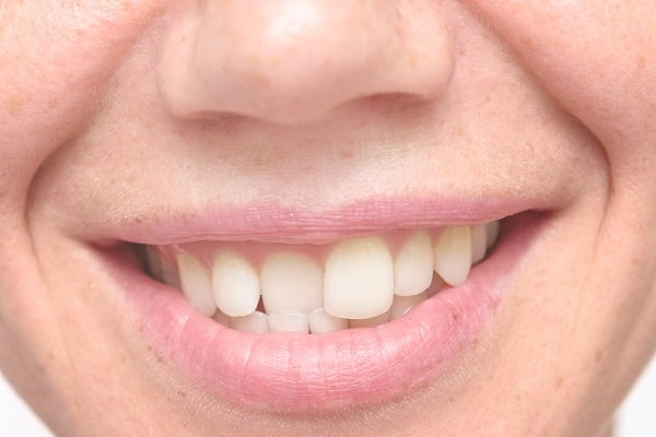 Woman With Crooked Teeth Prior to Porcelain Veneers