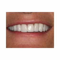 Neuromuscular and Full Mouth Rejuvenation