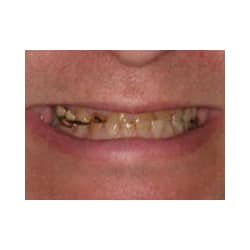 Neuromuscular and Full Mouth Rejuvenation