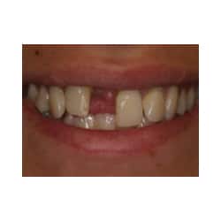 Dental Implant and All Porcelain Veneers