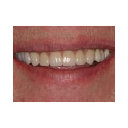 Dental Implant and All Porcelain Crowns