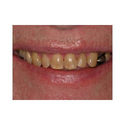 Dental Implant and All Porcelain Crowns