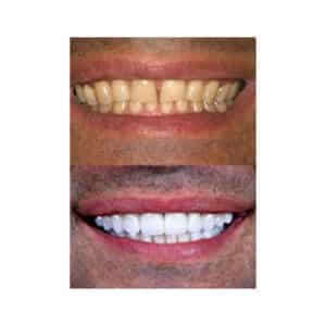 Neuromuscular and Full Mouth Rejuvenation