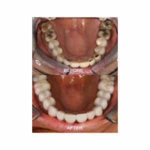 Neuromuscular and Full Mouth Rejuvenation