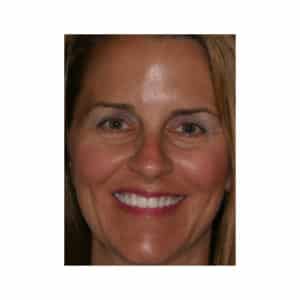 Neuromuscular and Full Mouth Rejuvenation