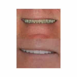Neuromuscular and Full Mouth Rejuvenation