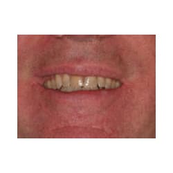 Before Image: Cosmetic Porcelain Veneers - front