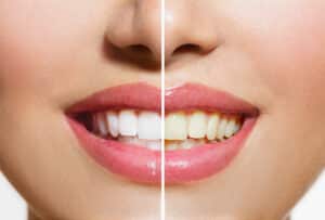 Woman,Teeth,Before,And,After,Whitening.,Over,White,Background.,Happy