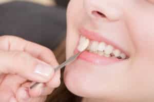 Dentist applies a porcelain veneer to patient's tooth in Oakton, VA 