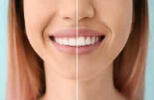 Before and after photo of a woman’s smile, showing a less gummy smile after gum recontouring treatment