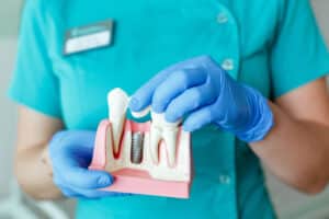 A dentist holding a model of a dental implant after tooth extraction