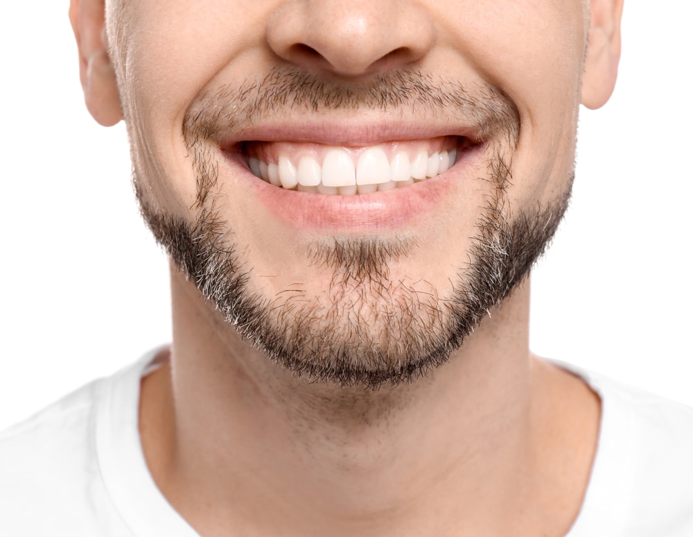 A close-up shot of a man's smile after getting dental implants