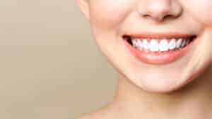 A close-up shot of a woman's smile after dental bonding in Oakton