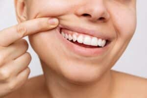 Woman lifts her lip with her fingers to show off healthy gums.