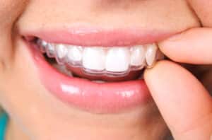 Clear dental aligner for straightening teeth