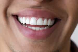 Natural-looking smile after porcelain veneers.