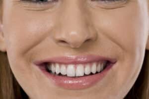 Close-up of smile after gum recontouring.